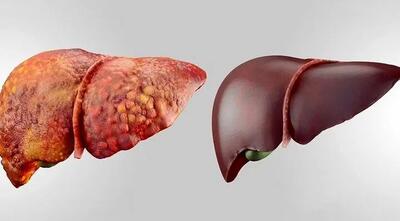  چرا کبد چرب خطرناک است؟