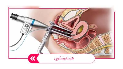  هیستروسکوپی چیست؟ / 12 سوال مهم درباره هیستروسکوپی + فیلم