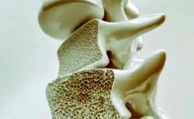  این علائم یعنی استخوان‌های شما پوک می‌شود!