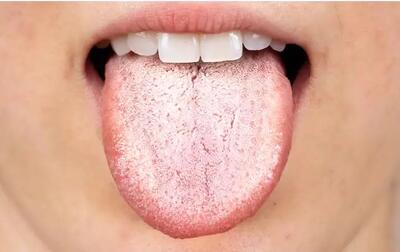  زبانت چه مزه‌ای می‌دهد؟ همین حالا از روی زبانت بیماری‌ات را کشف کن
