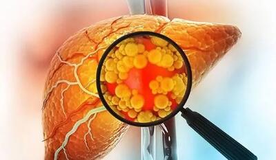  کبد چرب؛ از علائم تا راه‌های درمان