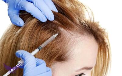  بهترین مرکز پی آر پی در تهران | معرفی 5 مرکز معتبر PRP + نکات مهم قبل از انتخاب