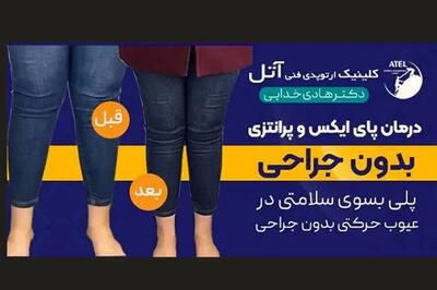  پای ایکس (ضربدری) چیست؟ روش‌های درمان آن