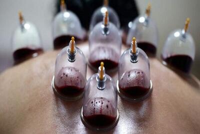  حجامت توسط افراد غیر متخصص خطرناک است