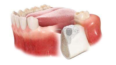  قیمت پودر استخوان دندانپزشکی؛ چطور باکیفیت‌ترین متریال پیوند را با هزینه مناسب بخریم؟