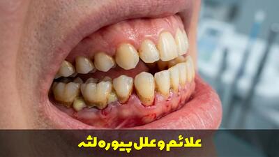  علائم و علل پیوره لثه چیست؟ + درمان دارویی و خانگی پیوره لثه