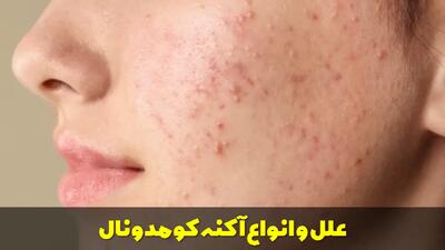  آکنه کومدونال | علل، انواع و بهترین روش های درمان