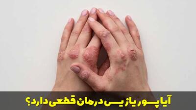  آیا پسوریازیس درمان قطعی دارد؟ مروری بر موثرترین روش های نوین