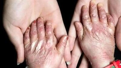  شناسایی ۴۹۲ گونه بیماری نادر و چالش‌های هزینه‌های درمانی در ایران