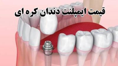  آشنایی با ایمپلنت کره‌ای +قیمت ایمپلنت کره‌ای، بهترین برند و مزایا