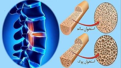 استعمال دخانیات و مصرف کورتون سبب افزیش احتمال ابتلا به پوکی استخوان میشود