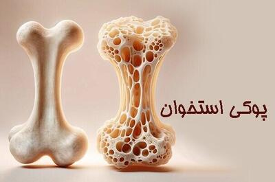  پوکی استخوان در خراسان شمالی؛ تهدیدی خاموش برای استحکام استخوان‌ها
