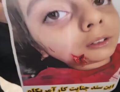  عکس تکان‌دهنده از یک کودک خردسال بعد از اصابت ساچمه به صورتش در جنایت لامرد