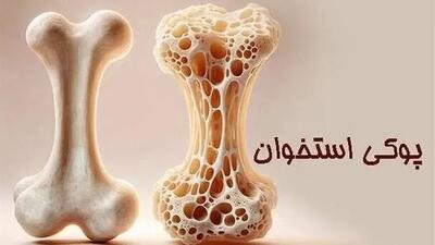  هشدار پزشکان؛ پوکی استخوان تا زمان شکستگی بی‌علامت است