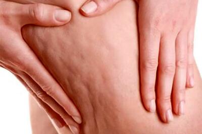 چند ترفند ساده برای کاهش سلولیت در خانه