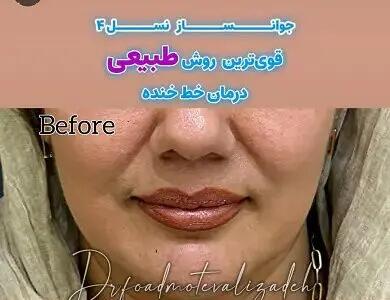  جوانساز هیبریدی نسل چهارم یا نخ مایع
