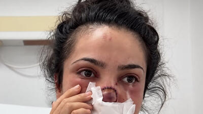 فیلم / شوهر این خانم از عصبانیت دماغشو گاز گرفت و از جا کند