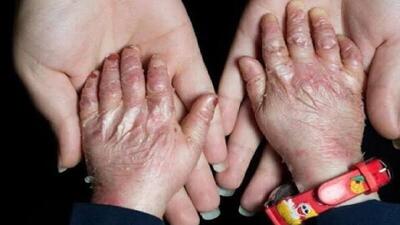 افزایش شناسایی بیماری‌های نادر به دلیل پیشرفت پزشکی
