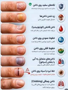  هر لکه و خط روی ناخن یک هشدار است؛ معنی آن‌ها را بدانید(اینفوگرافیک)