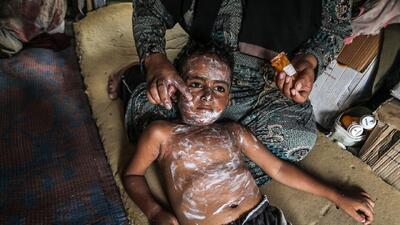  افزایش بی‌سابقه موارد آبله مرغان در غزه در بحبوحه شرایط دشوار بهداشتی