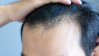 عارضه جانبی نگرانکننده داروهای لاغری که هیچکس در مورد آن صحبت نمیکند