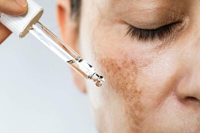  درمان لک قهوه ای صورت با روغن های گیاهی : معرفی ۷ روغن مؤثر + روش استفاده