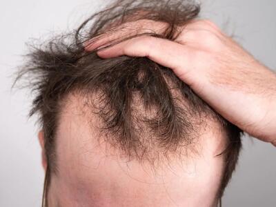  راهکاری مناسب برای مقابله با ریزش موی ژنتیکی