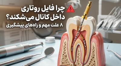 چرا فایل روتاری داخل کانال میشکند؟ 8 علت مهم و راههای پیشگیری