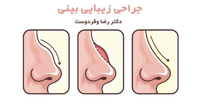 هزینه، راهنمایی و نکات حیاتی جراحی بینی