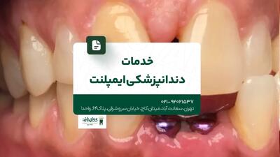  خدمات دندانپزشکی ایمپلنت
