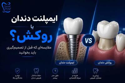 ایمپلنت دندان یا روکش؟ مقایسهای که قبل از تصمیمگیری باید بخوانید
