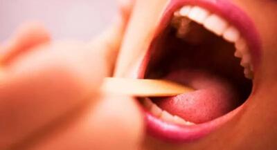 تشخیص زودهنگام سندرم سوزش دهان از درمانهای غیرضروری پیشگیری میکند