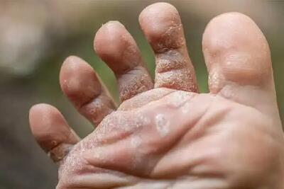 چرا پوست پا پوستهپوسته میشود؟ ۱۰ علت مهم را بشناسید