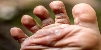 ۱۰ علت پوستهپوسته شدن پا