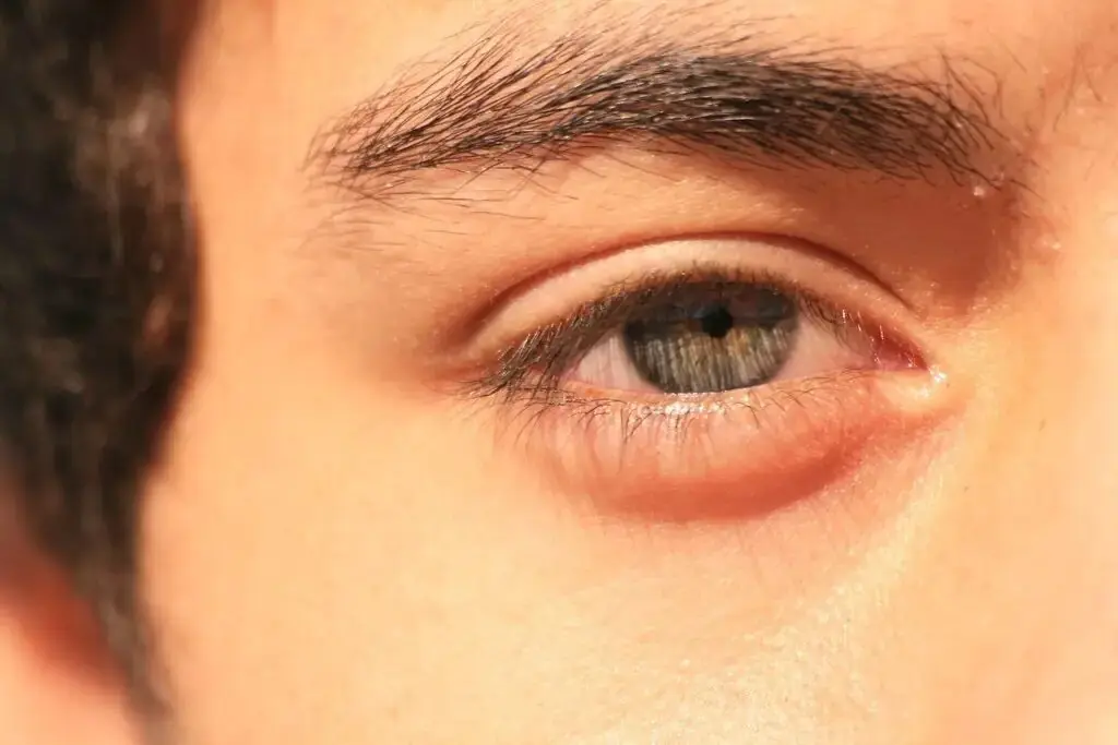  پف و تیرگی زیر چشم؛ علت‌ها و راهکارهای ساده برای رفع آن