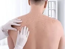 این لکهها و خالها را جدی بگیرید؛ زنگ خطر سرطان پوست