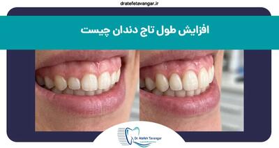  افزایش طول تاج دندان (لیفت لثه) چیست و چگونه انجام می‌شود؟
