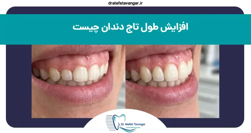 افزایش طول تاج دندان (لیفت لثه) چیست و چگونه انجام میشود؟