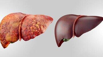 شایعترین بیماری کبدی جهان چیست؟