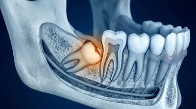 دندان عقل نهفته؛ چه زمانی جراحی ضروری میشود؟