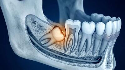 دندان عقل نهفته؛ چه زمانی جراحی ضروری میشود؟ - مردم سالاری آنلاین