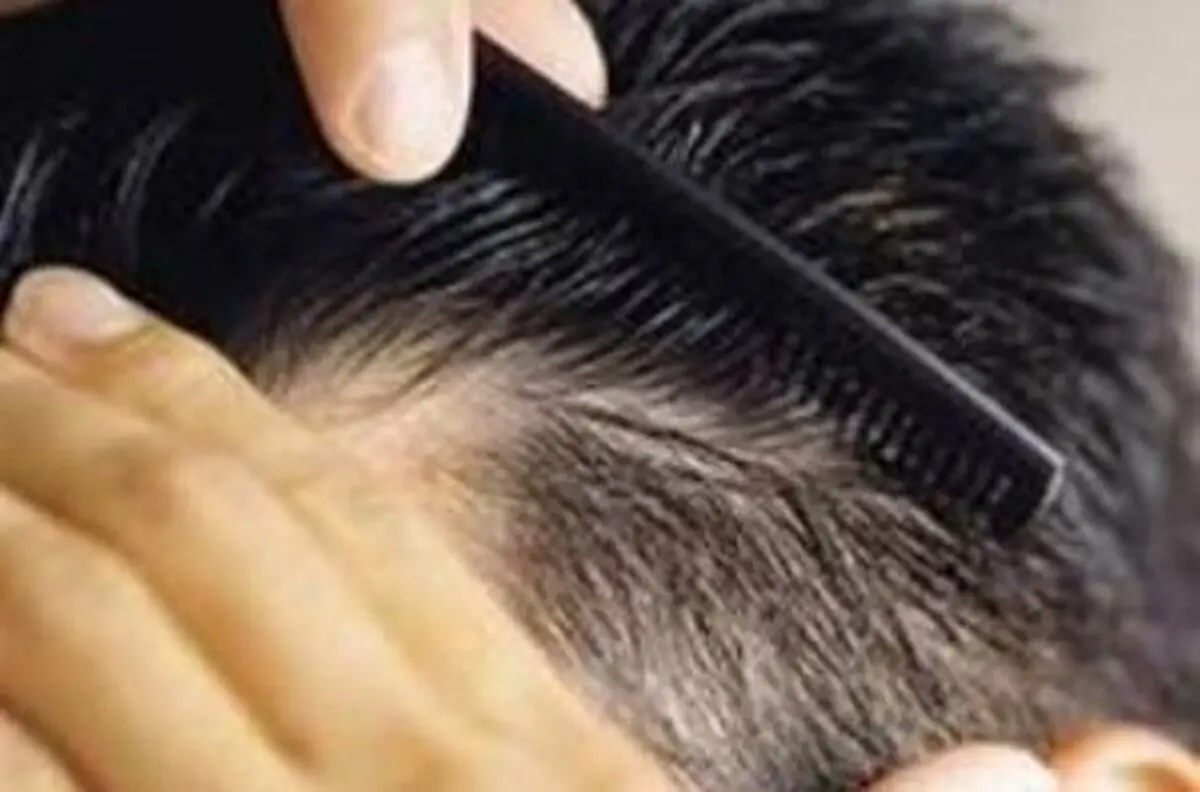 پژوهشگران مشهدی فرمولاسیون درمان شایعترین نوع ریزش مو را طراحی کردند