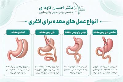  انواع عمل های معده برای لاغری - تسنیم