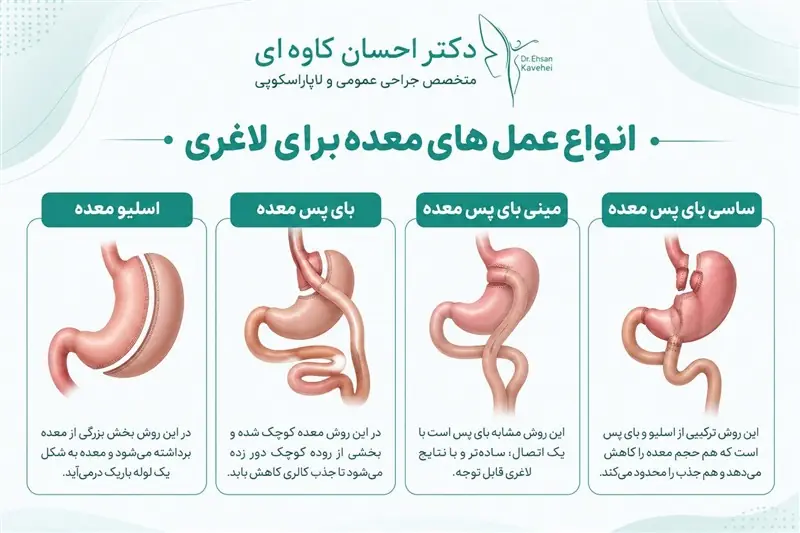  انواع عمل های معده برای لاغری - تسنیم
