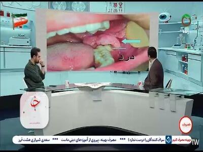  در چه مواقعی دندان نهفته عقل باید کشیده شود؟