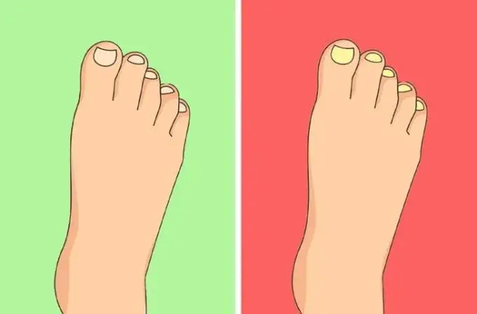 زردی ناخن؛ چه باید بکنیم؟