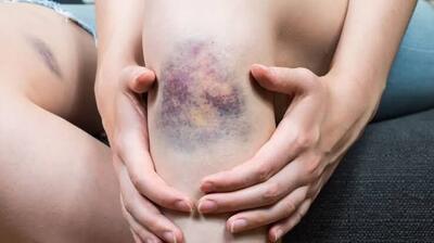  هشدار| مراقب کبودی های بی دلیل روی پوست خود باشید!