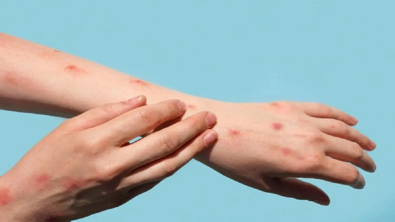 یک علت غیرمنتظره برای زخمهای پوستی