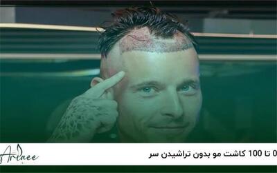 کاشت موی بدون تراشیدن (No Shave FUE) چیست و مناسب چه کسانی است؟