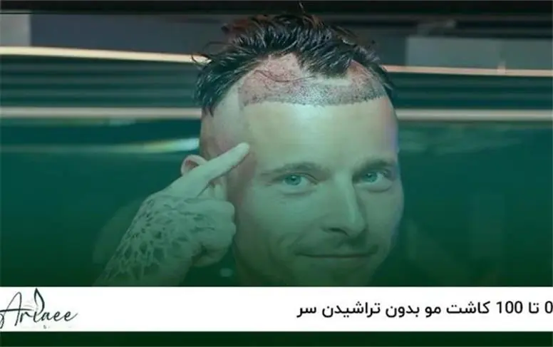  کاشت موی بدون تراشیدن (No Shave FUE) چیست و مناسب چه کسانی است؟